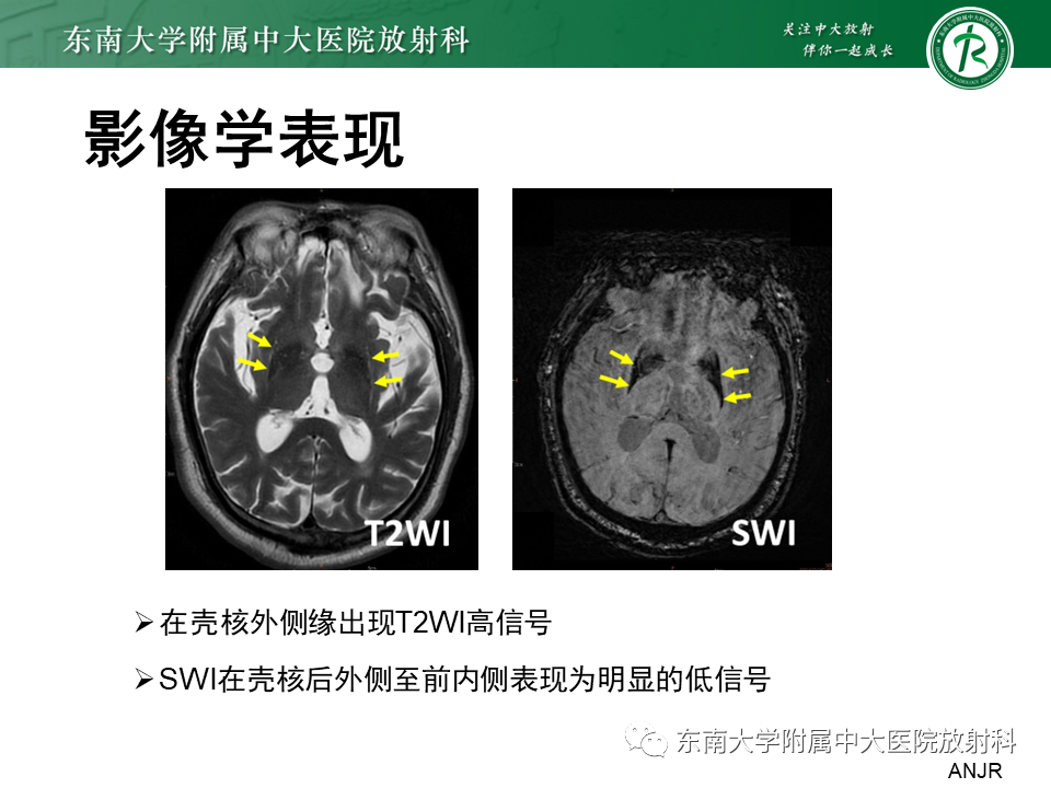 影像PPT - 【PPT】多系统萎缩-10
