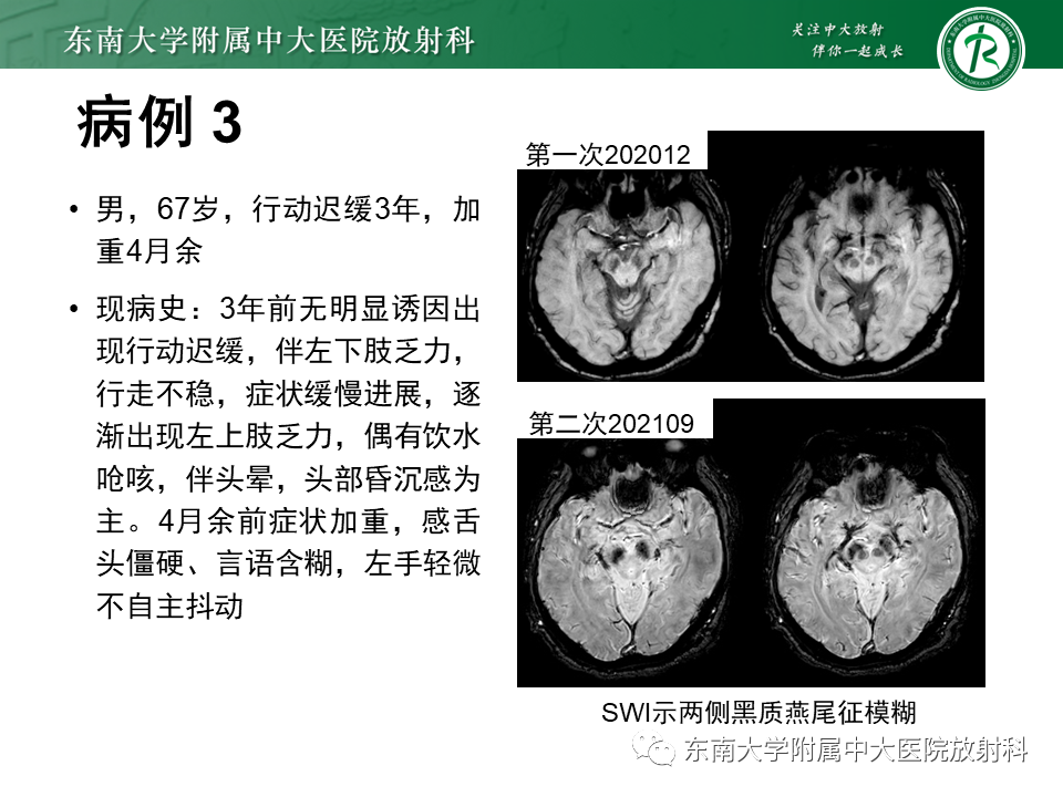 影像PPT - 【PPT】多系统萎缩-20
