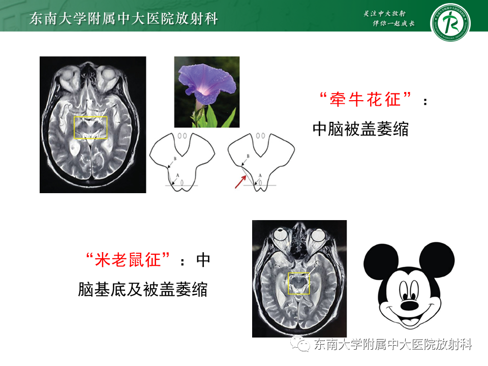 影像PPT - 【PPT】多系统萎缩-16