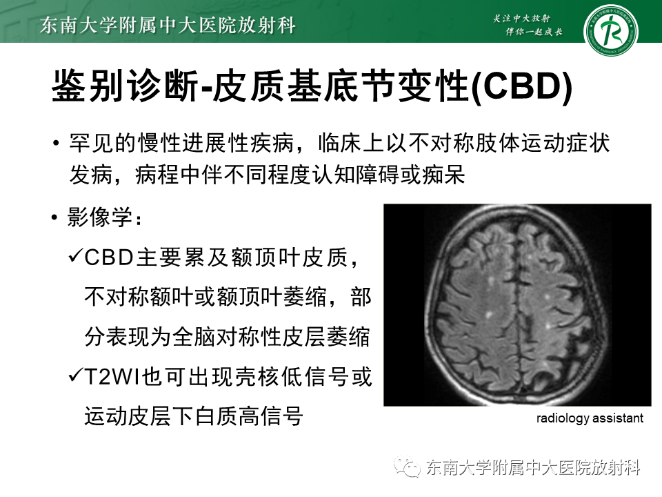 影像PPT - 【PPT】多系统萎缩-18