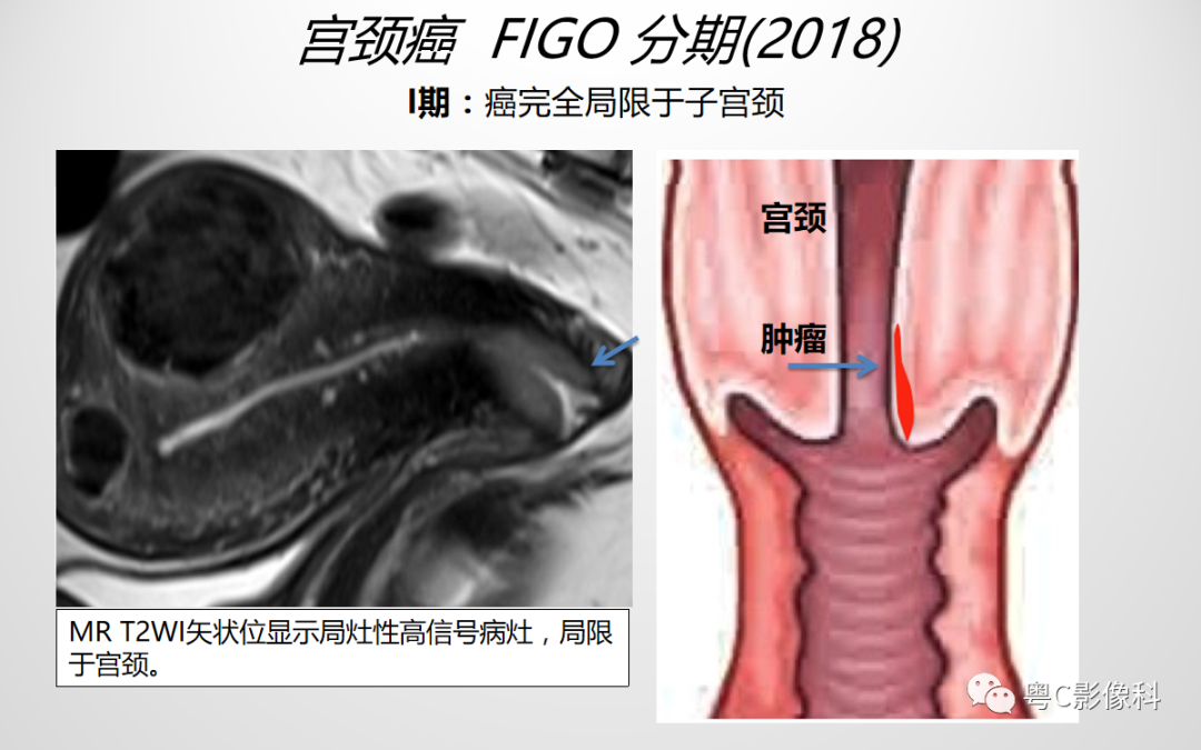 影像PPT - 【PPT】宫颈癌最新FIGO分期：2019年影像医生须知-8