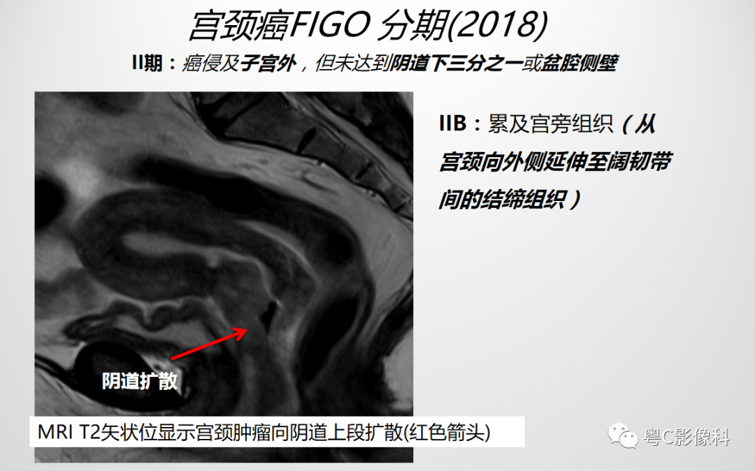 影像PPT - 【PPT】宫颈癌最新FIGO分期：2019年影像医生须知-9