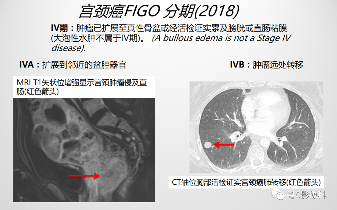影像PPT - 【PPT】宫颈癌最新FIGO分期：2019年影像医生须知-13