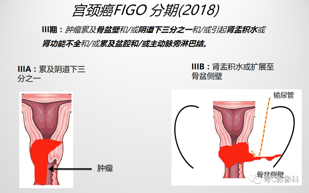 影像PPT - 【PPT】宫颈癌最新FIGO分期：2019年影像医生须知-11