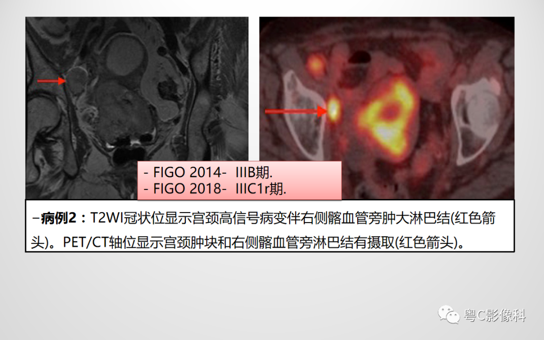 影像PPT - 【PPT】宫颈癌最新FIGO分期：2019年影像医生须知-22