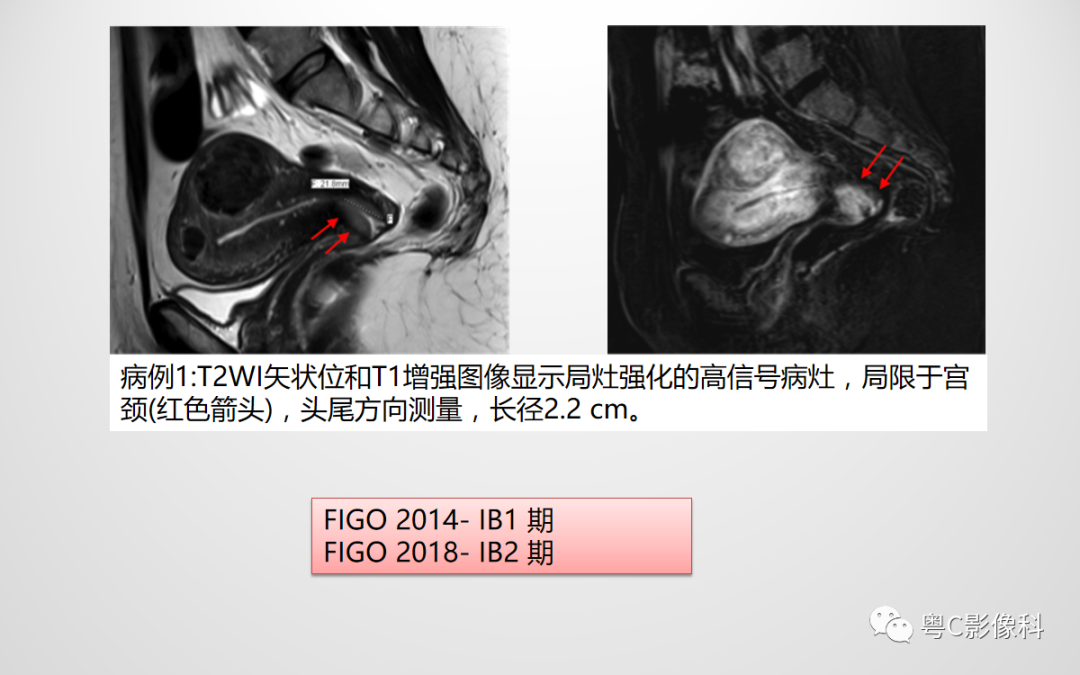 影像PPT - 【PPT】宫颈癌最新FIGO分期：2019年影像医生须知-16