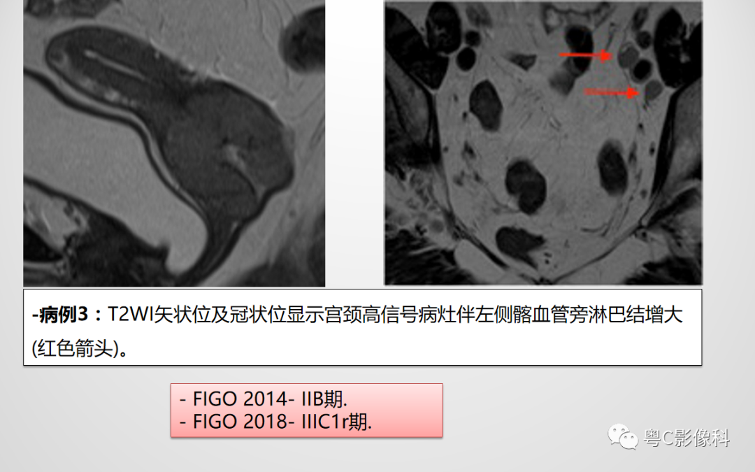影像PPT - 【PPT】宫颈癌最新FIGO分期：2019年影像医生须知-24