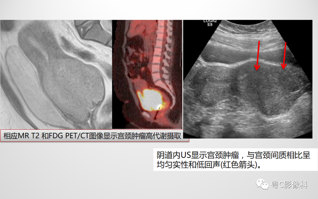 影像PPT - 【PPT】宫颈癌最新FIGO分期：2019年影像医生须知-31