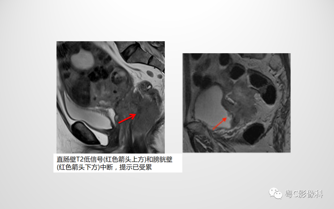 影像PPT - 【PPT】宫颈癌最新FIGO分期：2019年影像医生须知-38