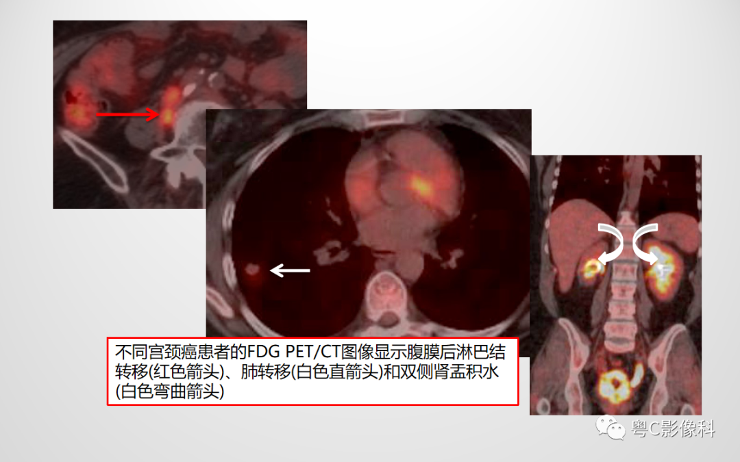 影像PPT - 【PPT】宫颈癌最新FIGO分期：2019年影像医生须知-40