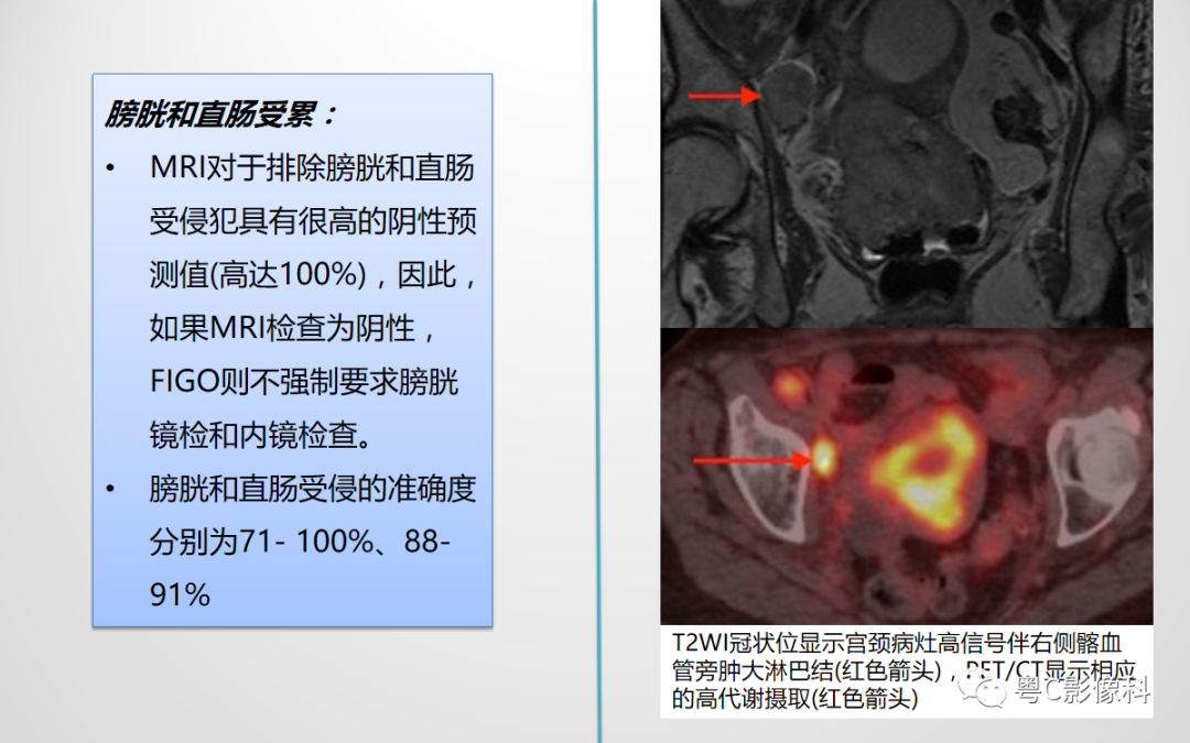 影像PPT - 【PPT】宫颈癌最新FIGO分期：2019年影像医生须知-37