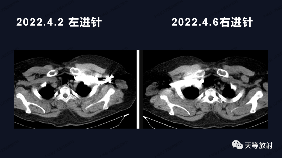 影像PPT - 【病例】上腔静脉综合征1例CT影像-8 影像PPT - 【病例】上腔静脉综合征1例CT影像-8