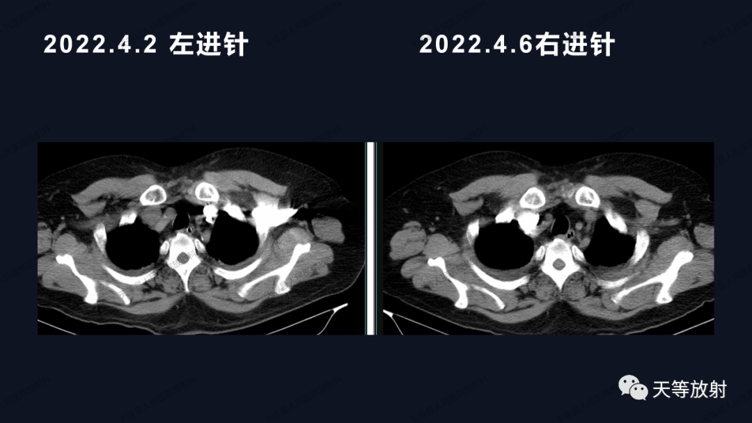 影像PPT - 【病例】上腔静脉综合征1例CT影像-9 影像PPT - 【病例】上腔静脉综合征1例CT影像-9