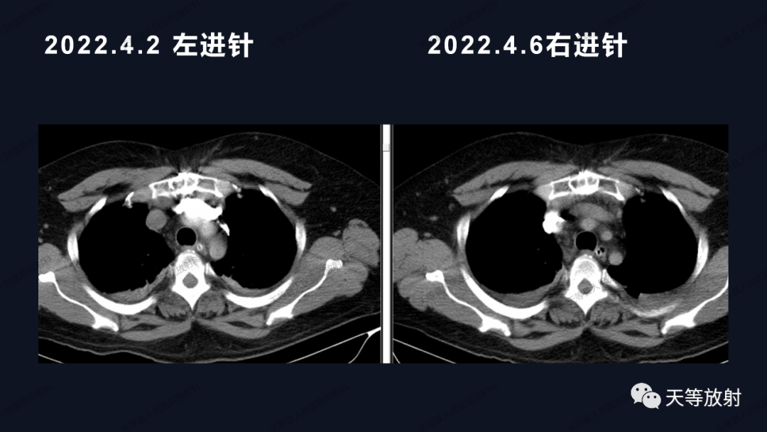 影像PPT - 【病例】上腔静脉综合征1例CT影像-11 影像PPT - 【病例】上腔静脉综合征1例CT影像-11