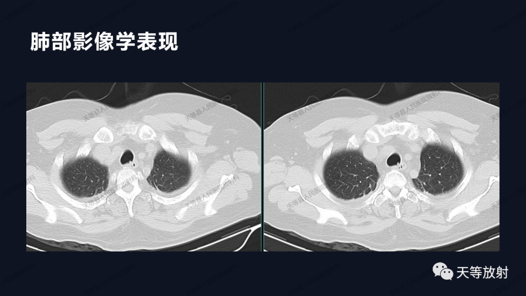 影像PPT - 【病例】上腔静脉综合征1例CT影像-2 影像PPT - 【病例】上腔静脉综合征1例CT影像-2
