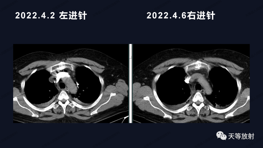 影像PPT - 【病例】上腔静脉综合征1例CT影像-12 影像PPT - 【病例】上腔静脉综合征1例CT影像-12