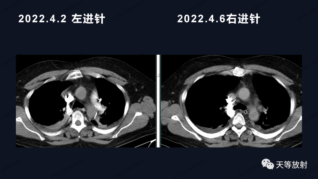 影像PPT - 【病例】上腔静脉综合征1例CT影像-13 影像PPT - 【病例】上腔静脉综合征1例CT影像-13