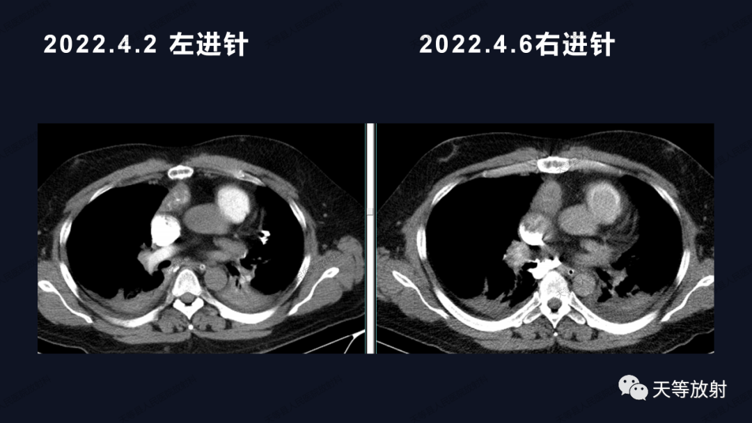 影像PPT - 【病例】上腔静脉综合征1例CT影像-16 影像PPT - 【病例】上腔静脉综合征1例CT影像-16