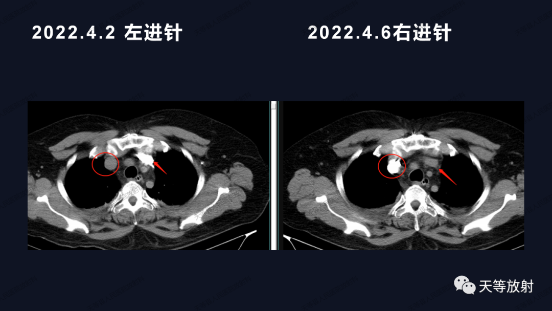 影像PPT - 【病例】上腔静脉综合征1例CT影像-10 影像PPT - 【病例】上腔静脉综合征1例CT影像-10