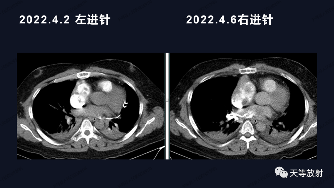 影像PPT - 【病例】上腔静脉综合征1例CT影像-18 影像PPT - 【病例】上腔静脉综合征1例CT影像-18