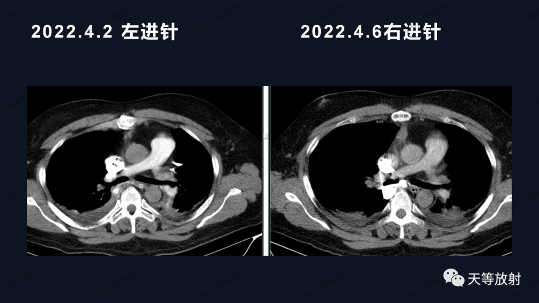 影像PPT - 【病例】上腔静脉综合征1例CT影像-14 影像PPT - 【病例】上腔静脉综合征1例CT影像-14