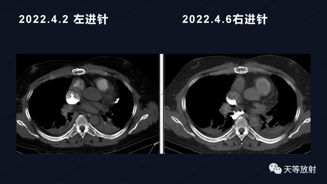 影像PPT - 【病例】上腔静脉综合征1例CT影像-20 影像PPT - 【病例】上腔静脉综合征1例CT影像-20