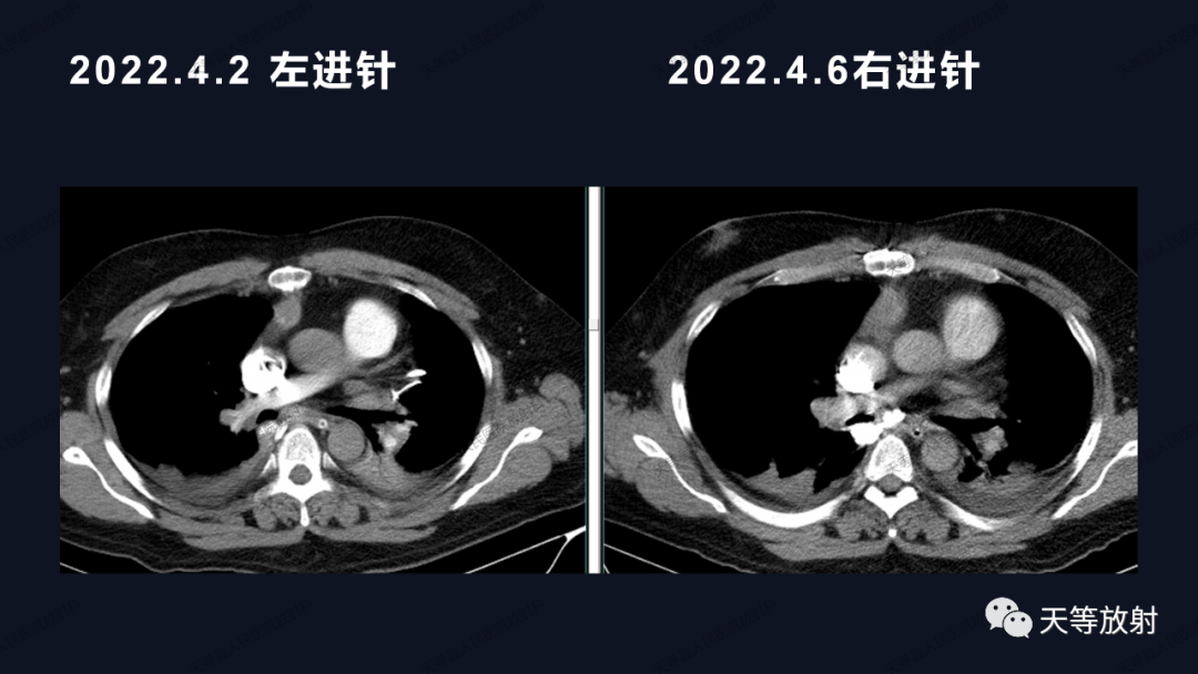 影像PPT - 【病例】上腔静脉综合征1例CT影像-15 影像PPT - 【病例】上腔静脉综合征1例CT影像-15