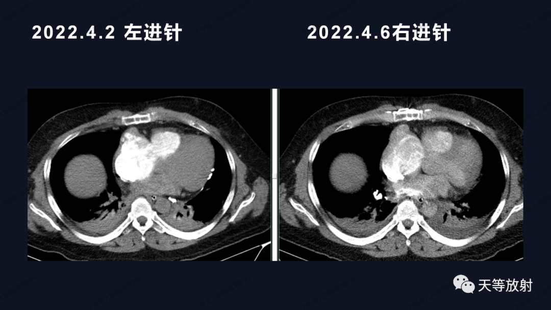 影像PPT - 【病例】上腔静脉综合征1例CT影像-19 影像PPT - 【病例】上腔静脉综合征1例CT影像-19