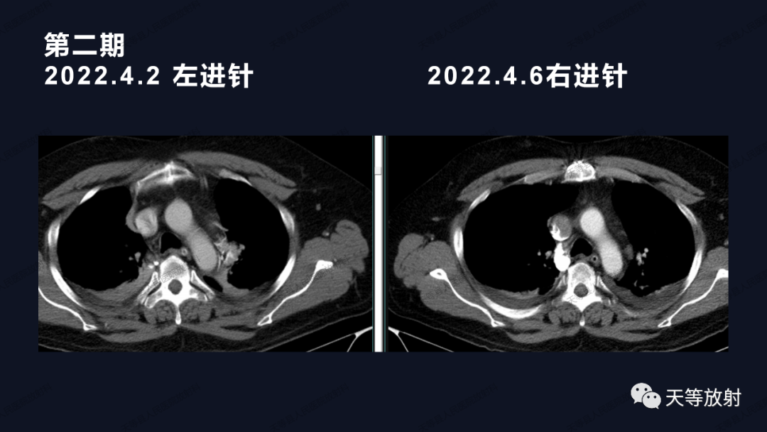 影像PPT - 【病例】上腔静脉综合征1例CT影像-23 影像PPT - 【病例】上腔静脉综合征1例CT影像-23