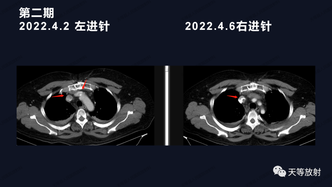 影像PPT - 【病例】上腔静脉综合征1例CT影像-21 影像PPT - 【病例】上腔静脉综合征1例CT影像-21