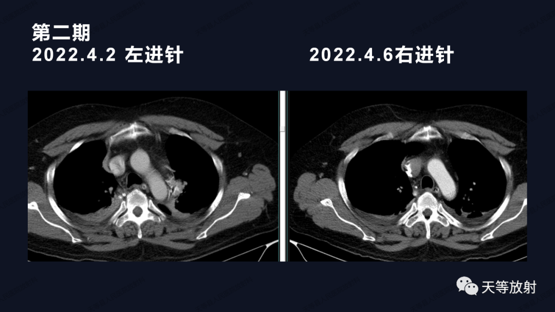 影像PPT - 【病例】上腔静脉综合征1例CT影像-22 影像PPT - 【病例】上腔静脉综合征1例CT影像-22