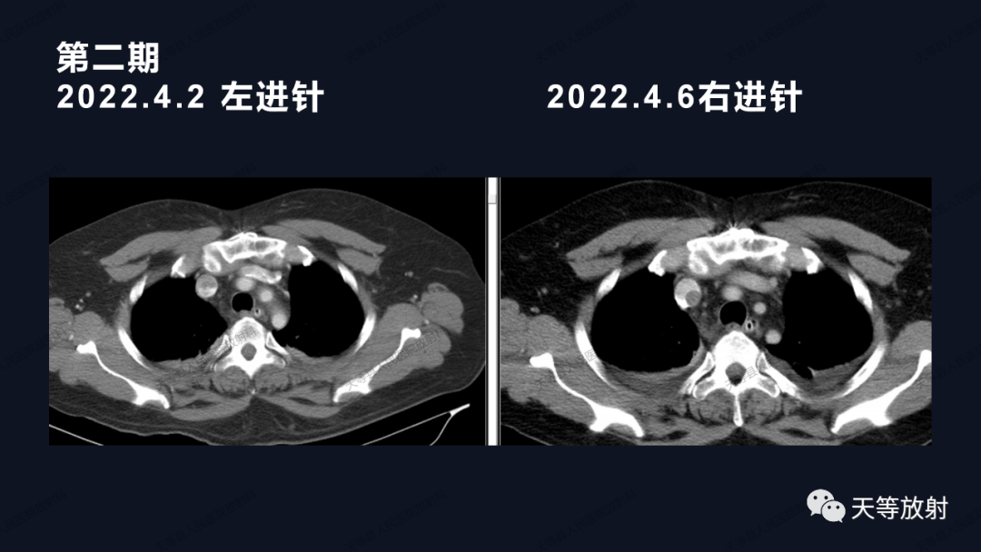 影像PPT - 【病例】上腔静脉综合征1例CT影像-26 影像PPT - 【病例】上腔静脉综合征1例CT影像-26