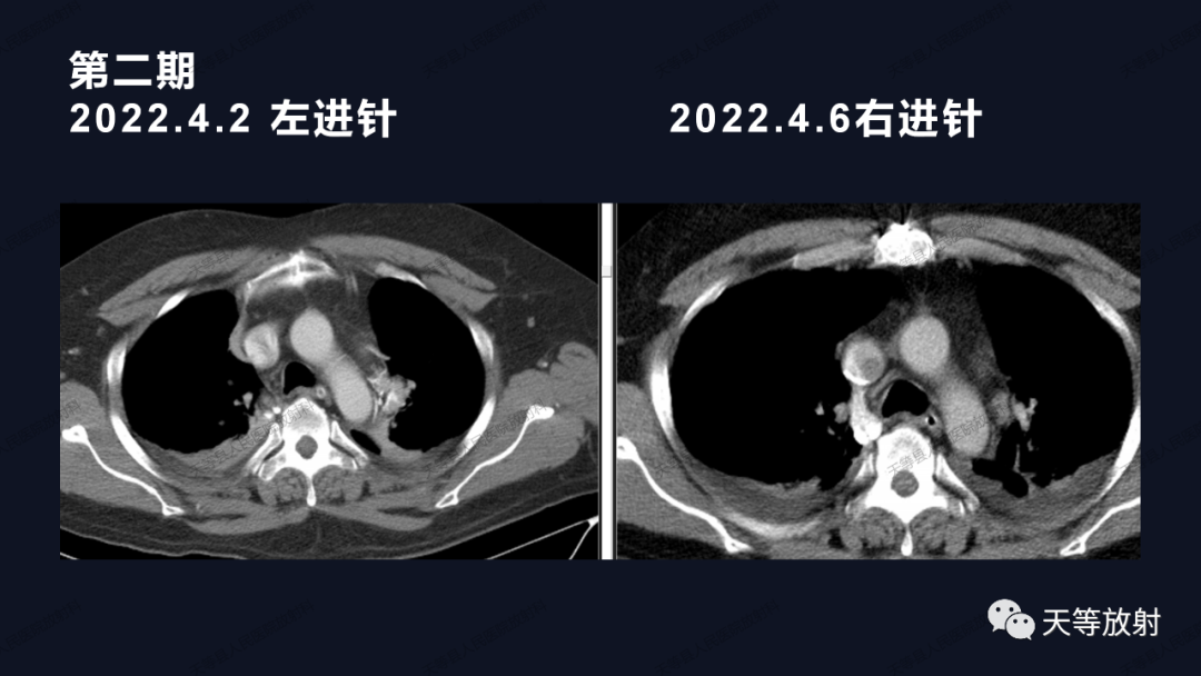 影像PPT - 【病例】上腔静脉综合征1例CT影像-27 影像PPT - 【病例】上腔静脉综合征1例CT影像-27