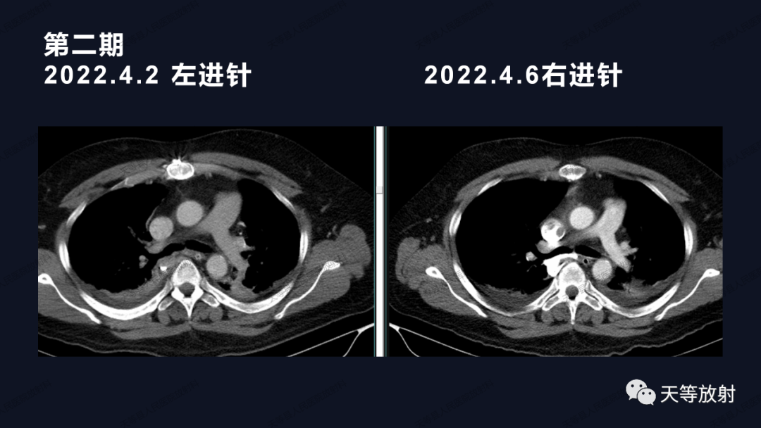 影像PPT - 【病例】上腔静脉综合征1例CT影像-24 影像PPT - 【病例】上腔静脉综合征1例CT影像-24