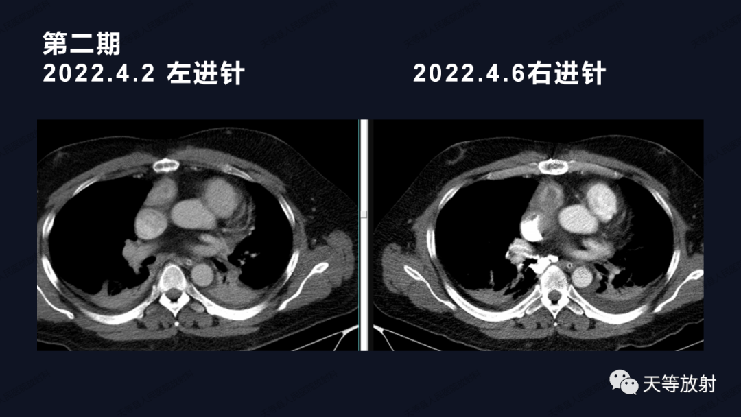 影像PPT - 【病例】上腔静脉综合征1例CT影像-25 影像PPT - 【病例】上腔静脉综合征1例CT影像-25