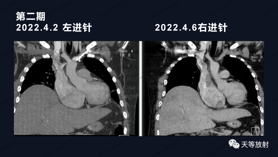 影像PPT - 【病例】上腔静脉综合征1例CT影像-30 影像PPT - 【病例】上腔静脉综合征1例CT影像-30