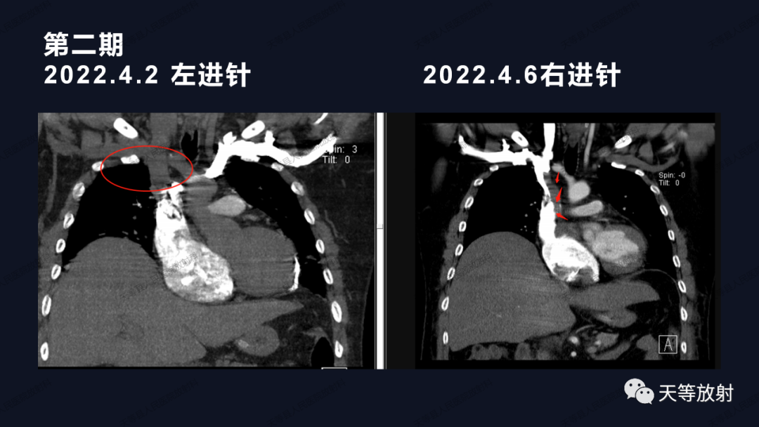 影像PPT - 【病例】上腔静脉综合征1例CT影像-29