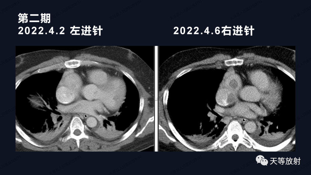 影像PPT - 【病例】上腔静脉综合征1例CT影像-28 影像PPT - 【病例】上腔静脉综合征1例CT影像-28