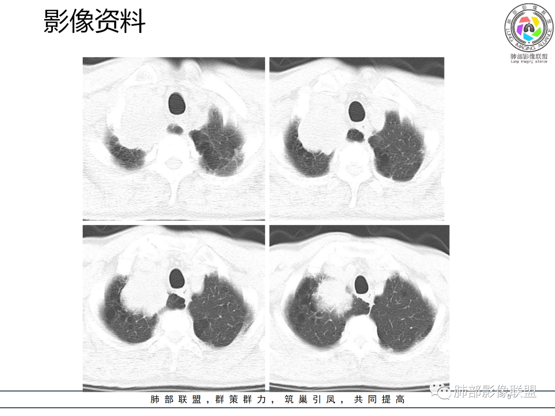 影像PPT - 【病例】癌肉瘤1例CT影像-5 影像PPT - 【病例】癌肉瘤1例CT影像-5
