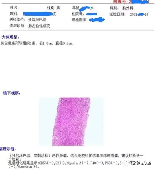 影像PPT - 【病例】癌肉瘤1例CT影像-25 影像PPT - 【病例】癌肉瘤1例CT影像-25