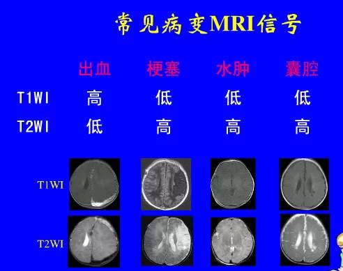 影像PPT - 【PPT】新生儿头部核磁共振成像-4