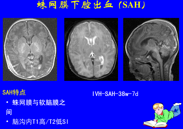 影像PPT - 【PPT】新生儿头部核磁共振成像-10