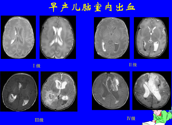 影像PPT - 【PPT】新生儿头部核磁共振成像-12
