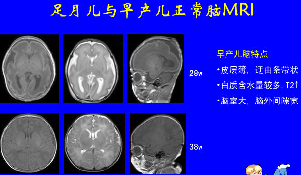 影像PPT - 【PPT】新生儿头部核磁共振成像-5