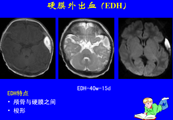影像PPT - 【PPT】新生儿头部核磁共振成像-8