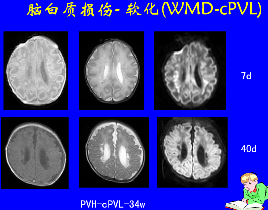 影像PPT - 【PPT】新生儿头部核磁共振成像-16