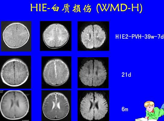 影像PPT - 【PPT】新生儿头部核磁共振成像-23