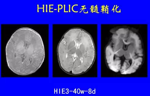 影像PPT - 【PPT】新生儿头部核磁共振成像-25