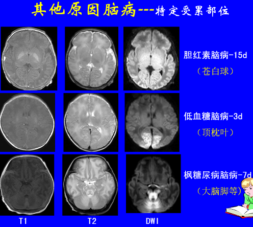 影像PPT - 【PPT】新生儿头部核磁共振成像-28
