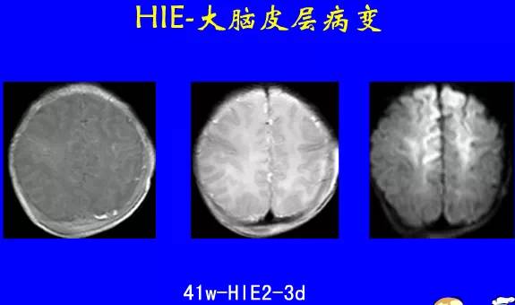 影像PPT - 【PPT】新生儿头部核磁共振成像-22